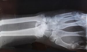 What to Do If Your Personal Injury Claim Is Denied